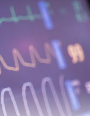 ECG